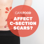 Scars After C-section