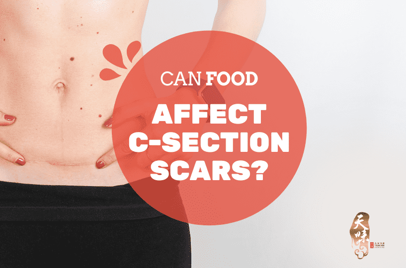 Scars After C-section Scars After C-section